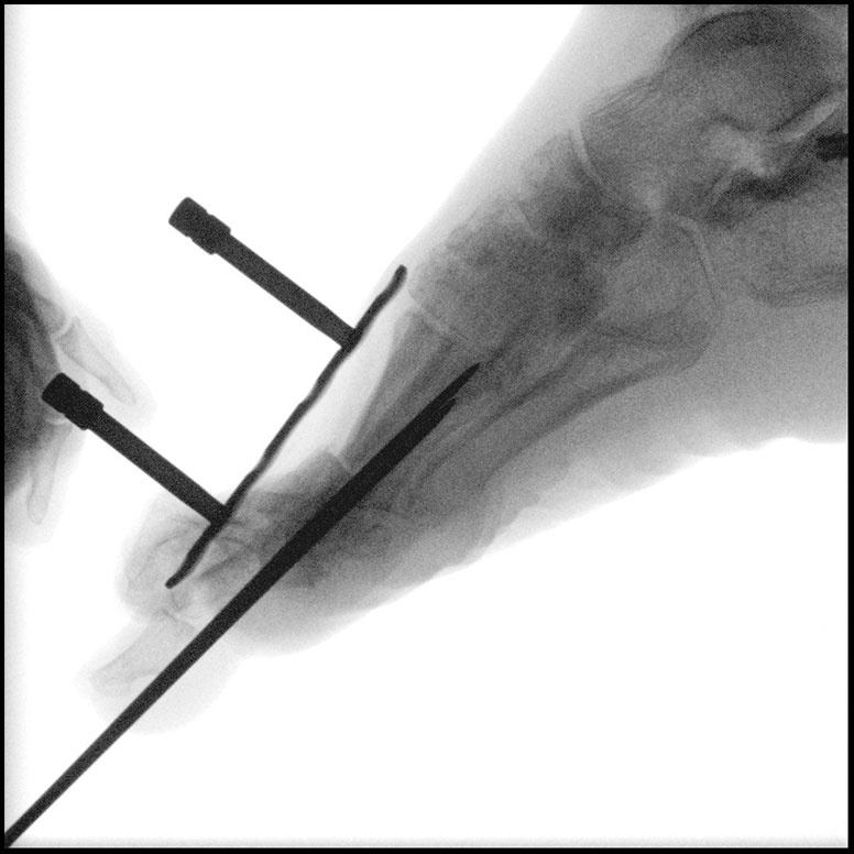 An intraoperative fluoroscopy view demonstrates placement of the tricortical cancellous calcaneal graft into the first MTPJ with fixation of locking screws, non-locking screws and a dorsal plate.