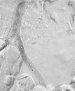 Vascular surgeons placed a left common iliac artery stent.