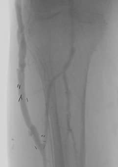 Repeat arteriogram with possible intervention was performed on 3/8/21