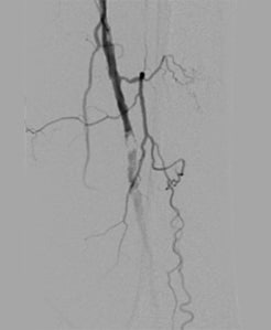 A proximal superficial femoral artery (SFA) to below-knee popliteal bypass was performed on 3/1/19.