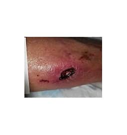 Serial wound debridement of the right leg ulcer facilitated a progression toward healing with local wound care. This initial clinical photo was taken on 1/24/20.