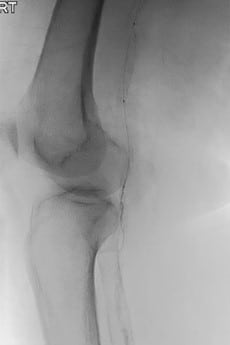 Here is an intraoperative view of an atherectomy of the popliteal and peroneal arteries. Note the 6 French sheath with the CSI Peripheral Orbital Atherectomy System (Cardiovascular Systems, Inc.).
