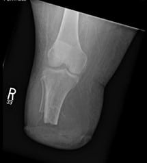  Radiographs of the BKA amputation stump were negative for any osseous pathology or soft tissue emphysema. 
