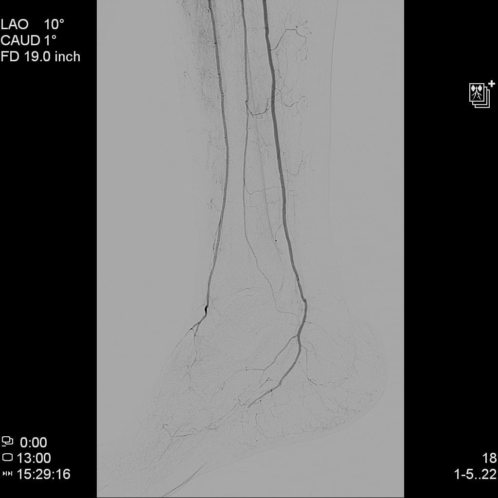 After focal angioplasty of the dorsalis pedis artery, the rates of flow through the AT and PT arteries were equivalent. Delayed imaging demonstrated more robust collateral vessel filling in the foot, providing a “blush” in the wound (see above).