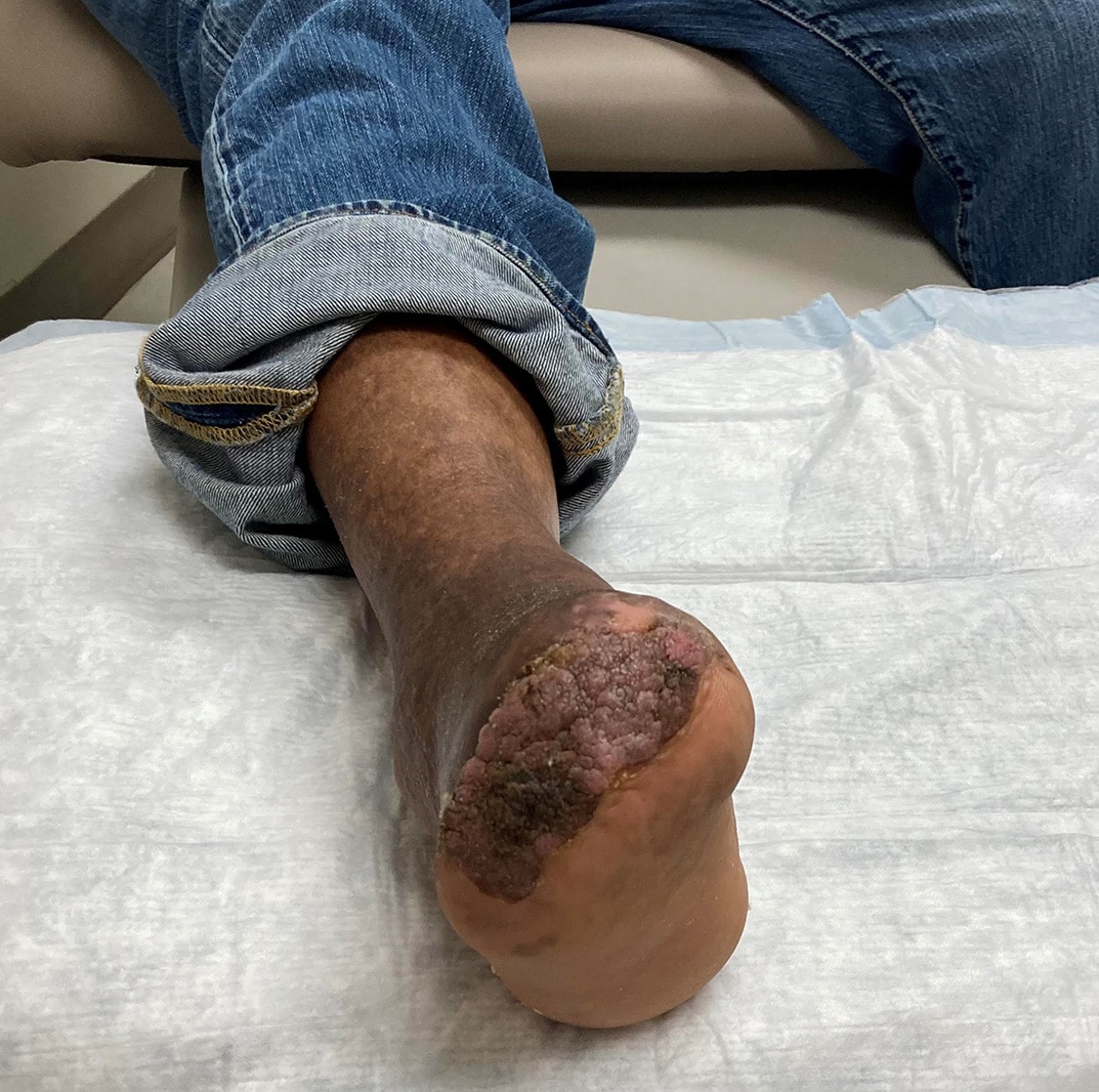 Here is the wound five weeks after the STSG application and 18 months prior to complete healing. The wound required occasional debridement of hyperkeratotic tissue that developed along the edge of the plantar flap and skin graft.