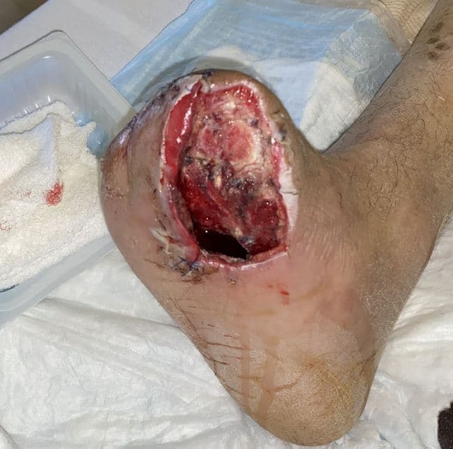 A 52-year-old patient with type 2 diabetes mellitus and severe peripheral neuropathy presented with an infected transmetatarsal amputation (TMA).