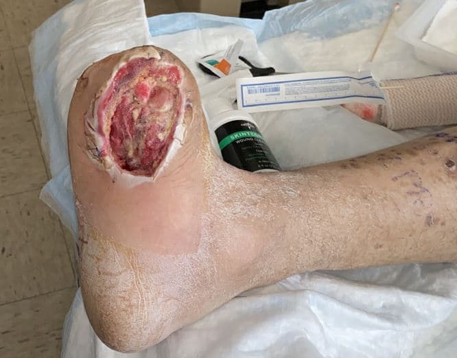 Serial wound debridement allowed for source control and a healthy granulating wound bed. However, a large tissue defect presented a significant clinical challenge.