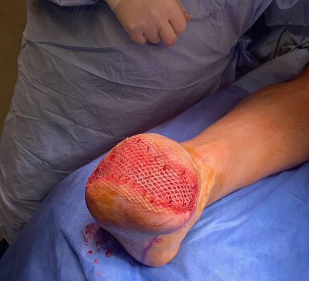 Here is an intraoperative view of the split-thickness skin graft (STSG) prior to application of portable NPWT.