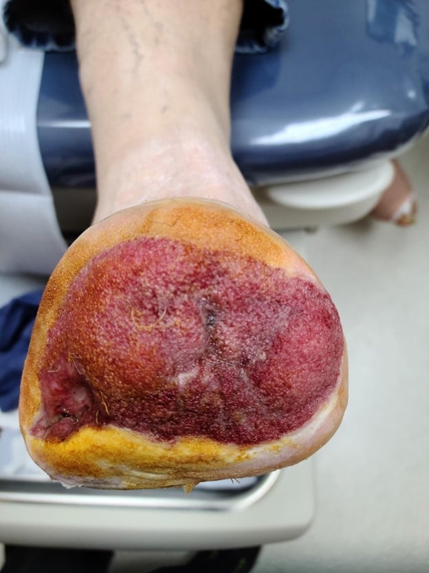 After being discharged from the hospital, the patient continued to receive negative pressure wound therapy (NPWT) for a transmetatarsal amputation wound. Over the next 12 weeks, the amputation site continued to decrease in size with increased granulation tissue noted (see above).