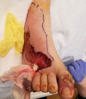 Here is the same foot after initial debridement at an outside hospital.