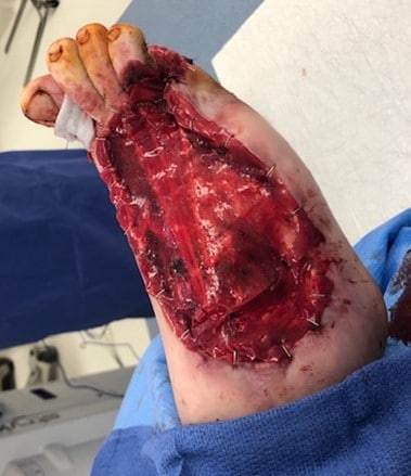 This photo of the foot was taken after additional debridement, proximal interphalangeal joint resection of the hallux, application of Integra Bilayer Matrix Wound Dressing over the wound, extensor hallucis longus lengthening, and metatarsophalangeal joint capsulotomy of the first through fourth digits.