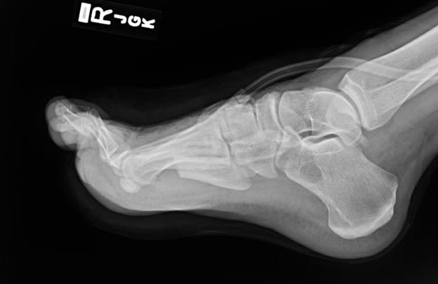 Note the lateral X-ray image of the right foot after hospital transfer and secondary debridement.