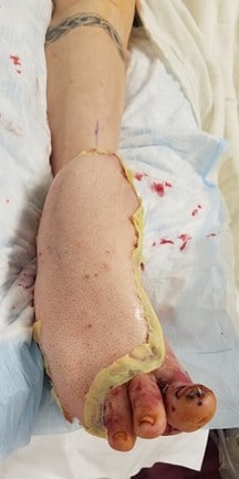 Here is another view of the foot 14 days after transfer of the left anterolateral thigh fasciocutaneous free flap to the dorsum of the right foot.