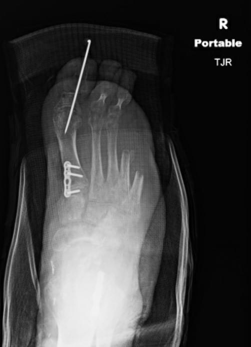 Note the anteroposterior X-ray image of the right foot immediately following cavus foot reconstruction.