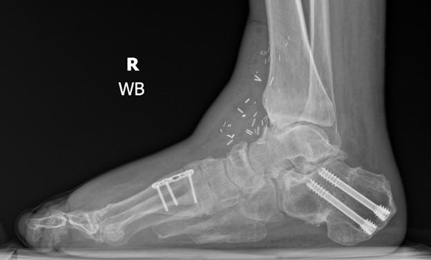 Here one can see a lateral X-ray image at an 18-month follow-up visit that demonstrates restoration of the plantigrade angle and talar first metatarsal axis.