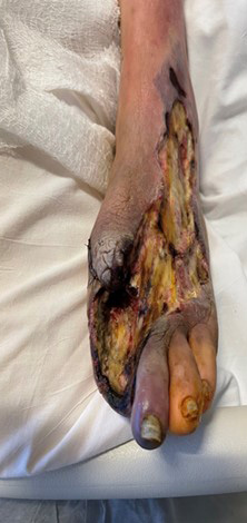 Here one can see the wound awaiting vascular intervention after infectious tissue has been removed