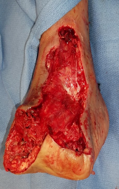 Note the partially open transmetatarsal amputation with a plantar lateral flap anchored to metatarsal bones through drill holes.