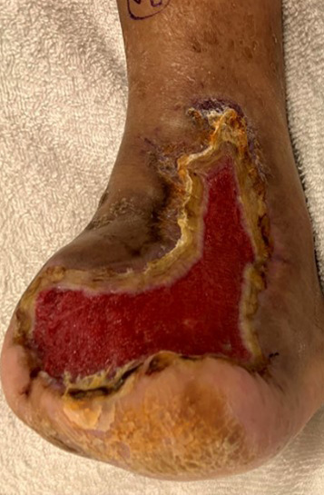 Here is a view of the postoperative wound prior to use of a split-thickness skin graft (STSG). 