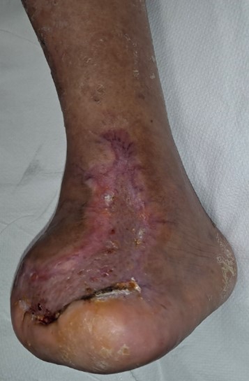 The patient had complete healing with graft incorporation four weeks after surgery. 