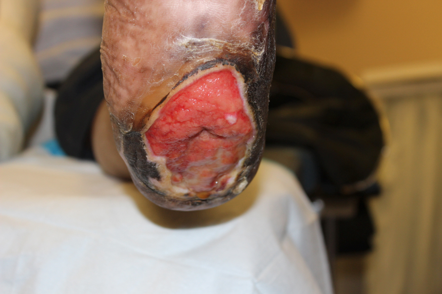 The patient presented with a third-degree scald wound on the left heel. Here one can see the wound after initial debridement at the hospital.