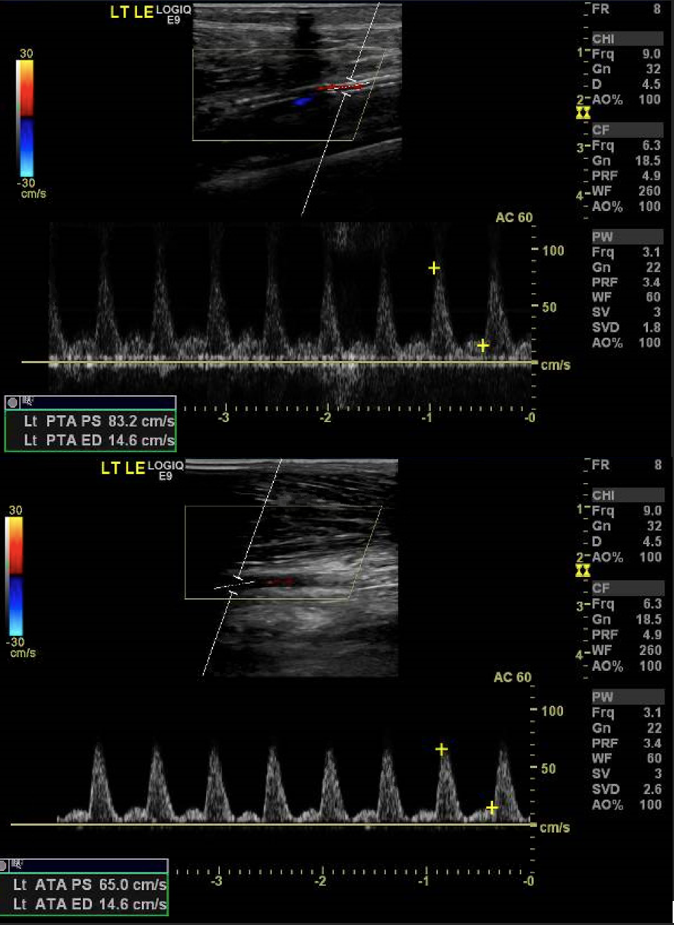 Arterial duplex ultrasound imaging of the proximal anterior and posterior tibial arteries revealed normal hemodynamic flow and a non-occlusive flow pattern.