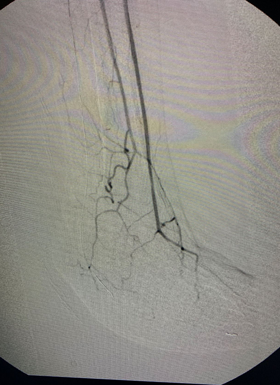 While angiography showed a normal anterior tibial (AT) artery, it also revealed occlusion of the distal posterior tibial artery.