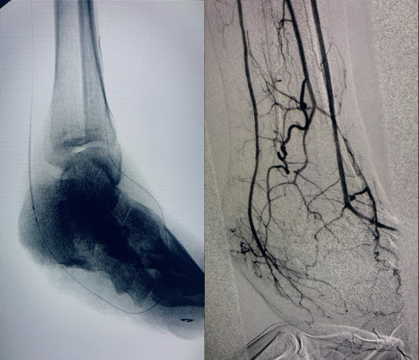 Repeat angiography again revealed an occluded distal PT, which was treated aggressively with atherectomy and angioplasty to reestablish the pedal loop (left). One can see wound blush and a partially revascularized pedal loop after intervention (right).