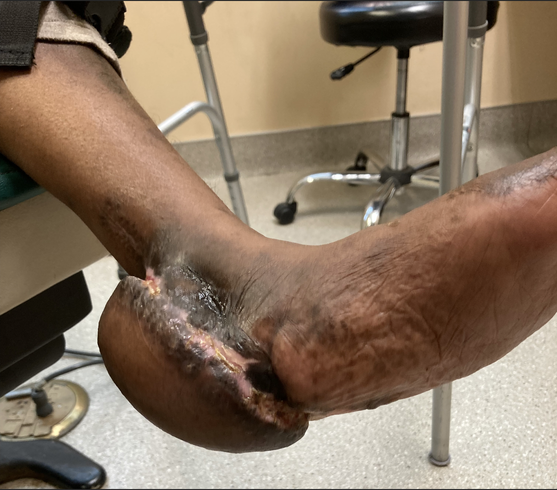 Approximately two months after application of an anterolateral thigh (ALT) free flap, the patient had a revisional procedure with a split-thickness skin graft to aid in wound coverage.