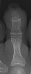 Radiographic imaging of the left second toe showed possible osseous erosion of the distal phalangeal tuft.