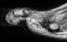 Here is a sagittal MRI of the left foot. This confirmed a sinus tract with contiguous osteomyelitis of the distal phalanx of the second toe.