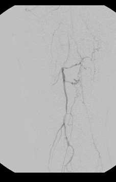  Intraoperative angiographic image demonstrating proximal SFA occlusion with short segment reconstitution.