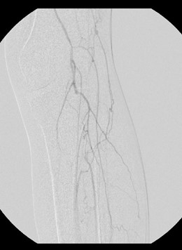 This intraoperative angiographic image shows distal popliteal and tibioperoneal trunk occlusions.