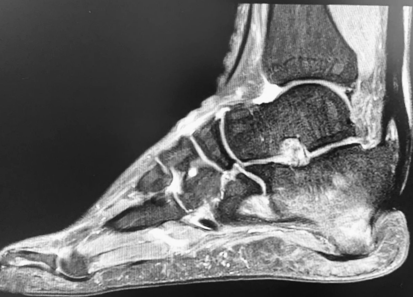 Patient Study: Diabetic Foot Amputations